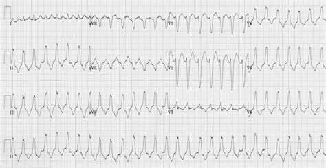 arrhythmogenic right ventricular dysplasia|arvc life expectancy.